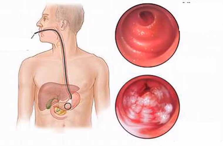 Liệu pháp sinh học. Đây là hình thức điều trị nhằm hỗ trợ hệ thống miễn dịch của cơ thể tấn công và giết chết tế bào ung thư, nó cũng giúp cơ thể hồi phục khi có một vài tác dụng phụ của điều trị.