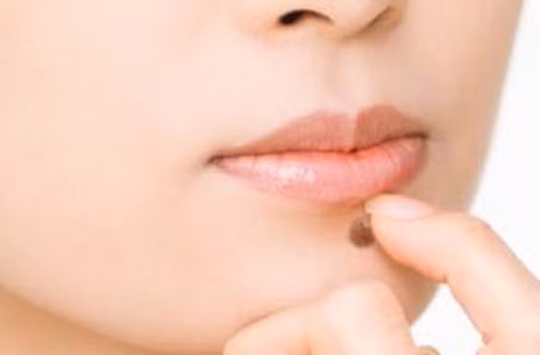 Bàn về vấn đề này, Marina Kvaskoff đến từ Bệnh viện Brigham &amp; Women’s và trường Y Harvard cho biết: "Nó có thể khiến chị em có nốt ruồi cảm thấy hoang mang. Tuy nhiên, việc có nhiều nốt ruồi không khẳng định điều gì chắc chắn. Chúng tôi hy vọng cảnh báo của mình khiến mọi người ý thức hơn về nguy cơ, dấu hiệu của căn bệnh tồi tệ”.