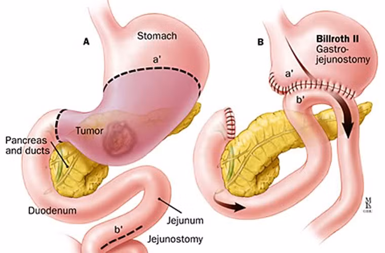 Trong đó, phẫu thuật là phương pháp điều trị đầu tiên và chủ yếu đối với những người ung thư dạ dày giai đoạn sớm. Phẫu thuật có thể cắt bỏ một phần, 2/3, 2/4, 4/5, thậm chí cắt toàn bộ dạ dày. Sau 5 ngày bệnh nhân ăn uống trở lại và chỉ khoảng sau 10 – 14 ngày là có thể xuất viện.