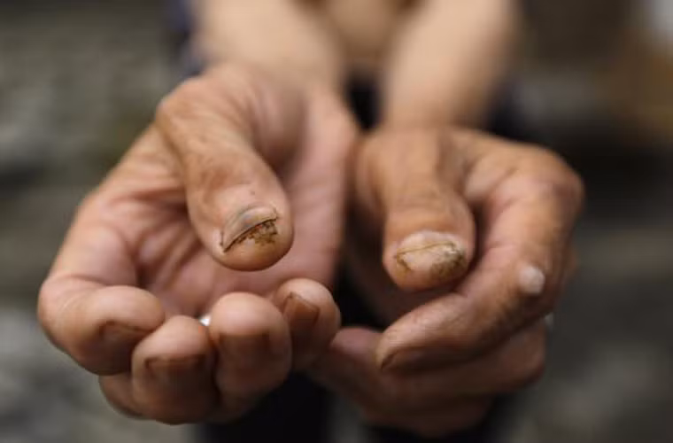 Quin Zhengyu, 78 tuổi, cũng mắc ung thư da. Bức ảnh chụp lại những khối u nhỏ trên ngón tay của bà.