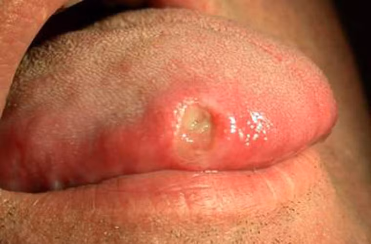 Ở độ tuổi 20. Tầm tuổi 20 - 30, thanh niên dễ mắc ung thư miệng, cổ họng, lưỡi hoặc ung thư cổ tử cung. Nguyên nhân bắt nguồn từ việc giới trẻ dễ lây nhiễm virus HPV khi quan hệ tình dục lành mạnh. Để giảm thiểu, bạn nên tiến hành tiêm chủng ngừa HPV. Tốt nhất, cần tiêm trước khi có quan hệ tình dục.