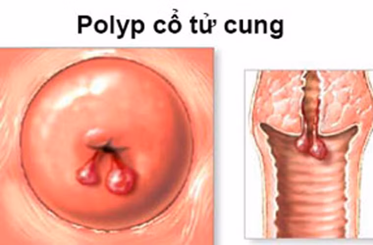 Nếu tế bào tiền ung thư được tìm thấy, các bác sĩ sẽ tiến hành điều trị và ngăn chặn trước khi nó chuyển biến thành bệnh. Hầu hết những trường hợp tế bào ung thư cổ tử cung di căn sang các bộ phận khác xảy ra ở những phụ nữ không xét nghiệm Pap thường xuyên.