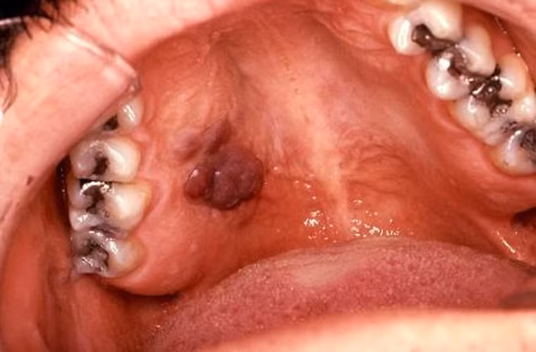 Khi dùng tay kiểm tra, khối u thường được bao quanh bởi một vành cứng. Ngoài ra, nó cũng dễ dàng được nhận diện bởi sự gia tăng về kích cỡ theo thời gian.