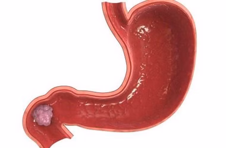 Để lựa chọn phương pháp điều trị ung thư dạ dày phù hợp với bệnh nhân, các bác sĩ dựa vào kích thước, vị trí khối u, giai đoạn phát hiện bệnh và thể trạng từng người.