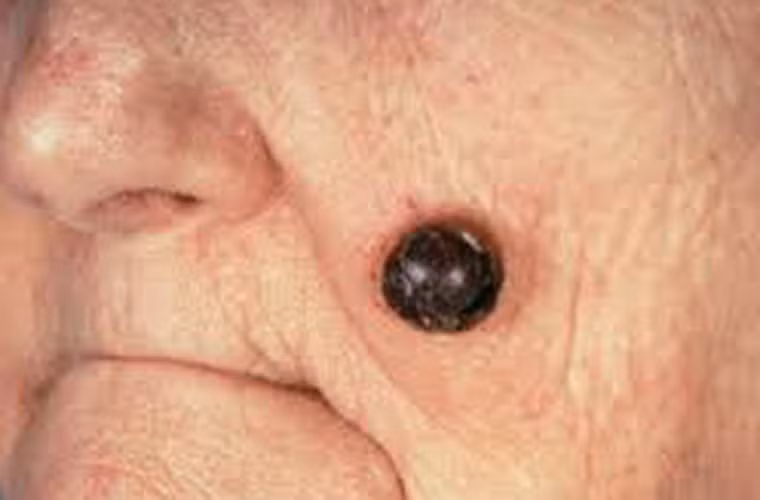 Nghiên cứu thứ hai, các nhà khoa học tiến hành nghiên cứu ở 89.900 phụ nữ. Các nhà khoa học chỉ yêu cầu họ báo cáo liệu mình có, có ít, nhiều hay rất nhiều nốt ruồi. Từ đó, các chuyên gia phân tích và đưa ra kết quả người có nhiều nốt ruồi dễ mắc ung thư vú hơn 15% so với chị em không có nốt ruồi.