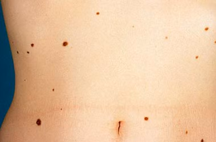 Các nhà khoa học trấn an chị em không nên quá sốt sắng về kết quả trên. Nguyên nhân là, nghiên cứu đầu tiên các nhà khoa học tiến hành nghiên cứu trên 74.500 nữ y tá. Họ được yêu cầu thống kê số lượng nốt ruồi lớn hơn 3mm trên cánh tay trái, giữa vai và cổ tay. Kết quả là những người có hơn 15 nốt ruồi ở đây có khả năng mắc ung thư vú cao hơn 35%.