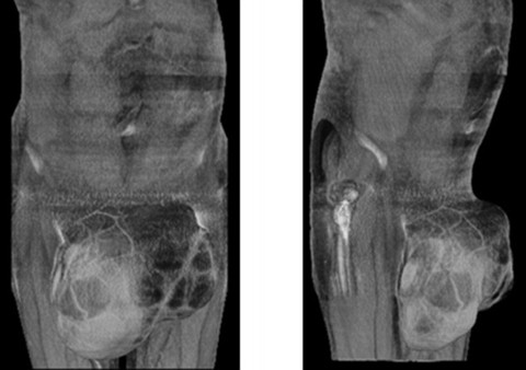 Từ một chấm nhỏ, khối u trở nên to bất thường chỉ sau 12 tháng.