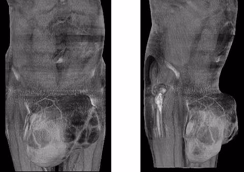 Từ một chấm nhỏ, khối u trở nên to bất thường chỉ sau 12 tháng. Từ một chấm nhỏ, khối u trở nên to bất thường chỉ sau 12 tháng.