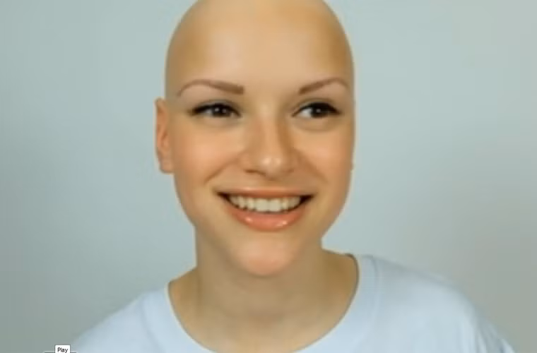 Việc mất đi mái tóc yêu quý có thể khiến bệnh nhân cảm thấy bất lực, tự ti về vẻ ngoài của mình. Thậm chí, nó có thể dẫn đến tình trạng trầm cảm nghiêm trọng, tổn thương về tinh thần.