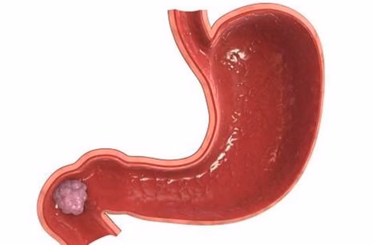 Thực tế, những người có nồng độ alpha – carotene và beta – carotene trong cơ thể thấp dễ dàng đối diện với căn bệnh ung thư dạ dày nguy hiểm. Để bổ sung sự thiếu hụt này, họ chỉ cần tăng cường ăn các loại rau màu cam và vàng như bí ngô, cà rốt.