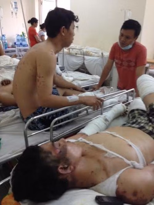 Công nhân Nguyễn Thanh Long (ngồi) bị bỏng nặng 2 chân. Phần cơ thể chỉ bị bỏng nhẹ do nhờ có quần áo bảo hộ lao động.