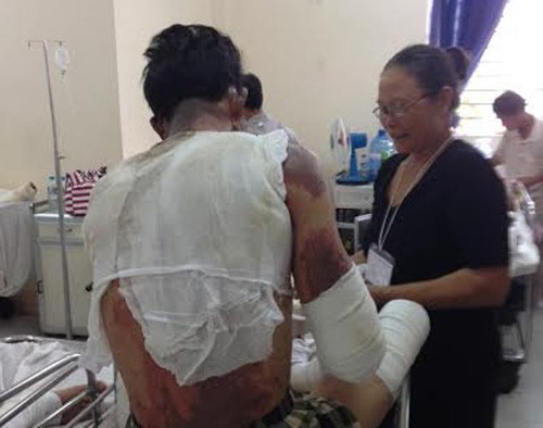Nạn nhân vụ nổ lò nấu thép công ty cổ phần Thép Pomina 3 đang điều trị tại BV Chợ Rẫy.