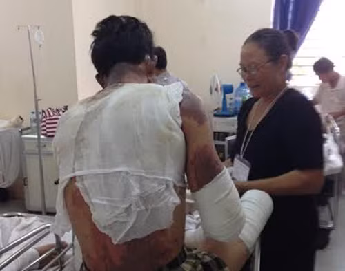 Nạn nhân vụ nổ lò nấu thép công ty cổ phần Thép Pomina 3 đang điều trị tại BV Chợ Rẫy.