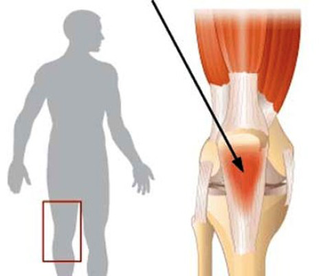 Viêm gân bánh chè.