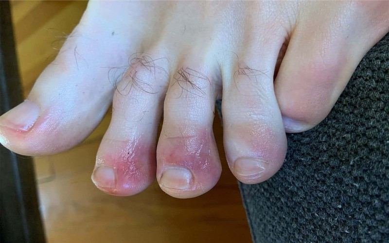 Đôi bàn chân: Các vết loét ở bàn chân được đặt biệt danh là “ngón chân Covid” đã được ghi nhận là một triệu chứng kỳ lạ liên quan đến virus corona, gây ra vết loét màu tím ở chân.