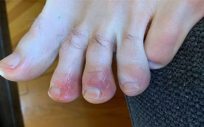 Đôi bàn chân: Các vết loét ở bàn chân được đặt biệt danh là “ngón chân Covid” đã được ghi nhận là một triệu chứng kỳ lạ liên quan đến virus corona, gây ra vết loét màu tím ở chân.