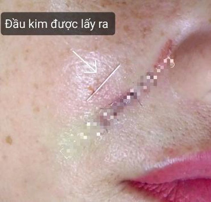 Gay kim khi dang tiem filler xoa ranh mui ma o tiem toc