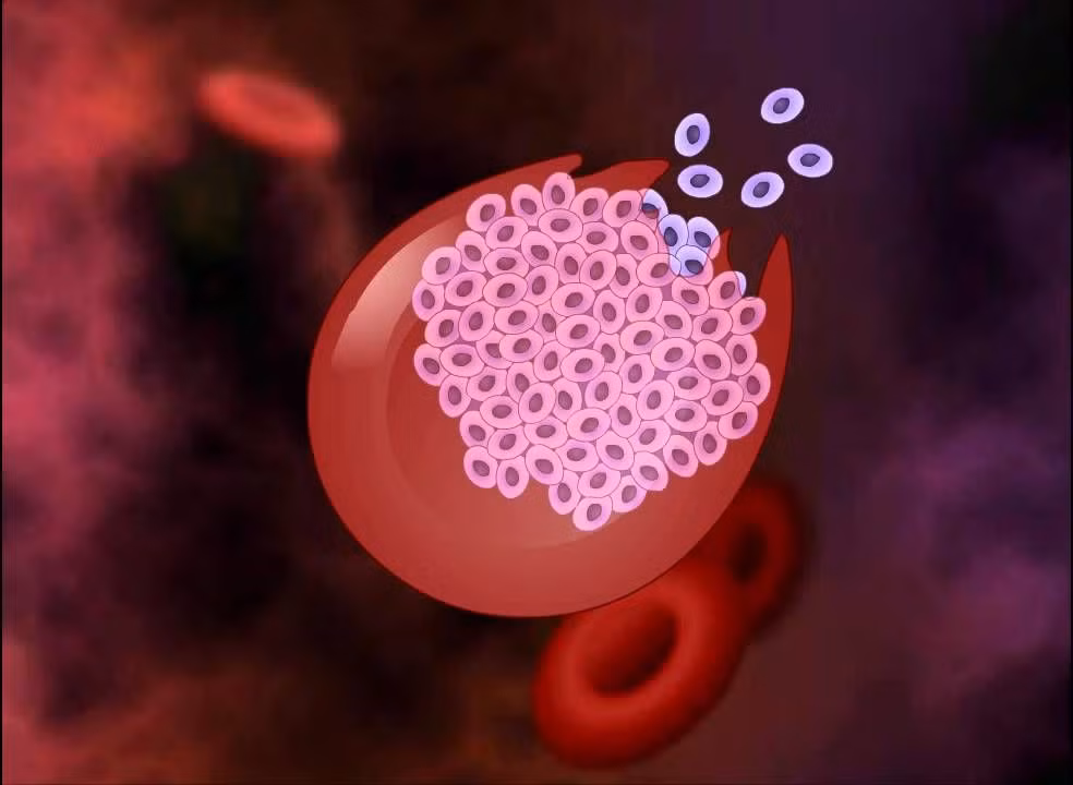 Đây là một chứng bệnh gây ra bởi ký sinh trùng tên Plasmodium, lây truyền từ người này sang người khác khi những người này bị muỗi đốt.