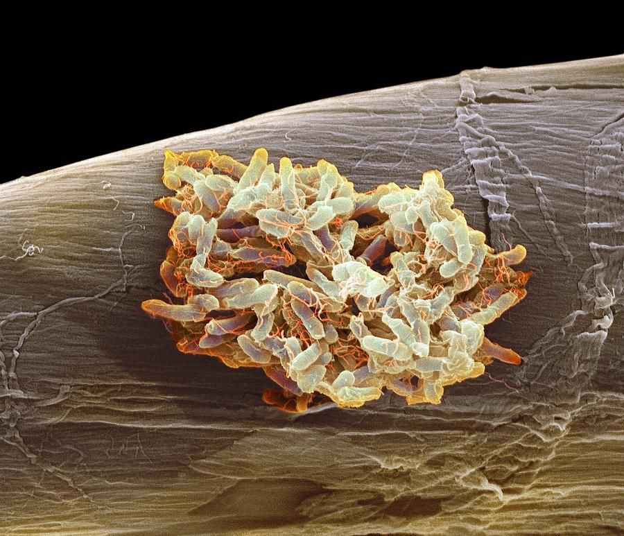 Đây chính là những miêu tả cô đọng về bệnh thương hàn, chứng bệnh đường tiêu hóa do nhiễm vi trùng Salmonella enterica serovar Typhi gây ra.