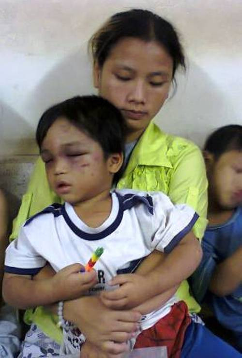Cháu Đức với thương tích đầy người, 2 mắt tím bầm mệt mỏi lim dim ngủ trong tay mẹ