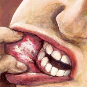 3. Một miếng loét lớn màu trắng hoặc màu đỏ khác thường trên nướu răng, lưỡi hoặc lớp lót bên trong miệng, phía bên trong của môi có thể chứng tỏ là ung thư.