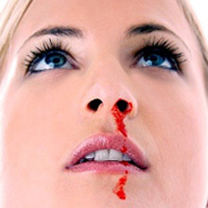 Chảy mũi nhầy lẫn mủ hay lẫn máu, chảy máu mũi.