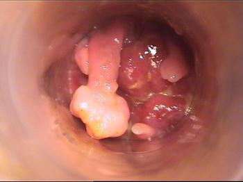  3. U cục: Ở phần viền hậu môn xuất hiện cục u nhỏ, phát triển chậm. Lúc này, tốt nhất nên đến bệnh viện để chụp CT, đồng thời có thể xác định được tính chất khối u.