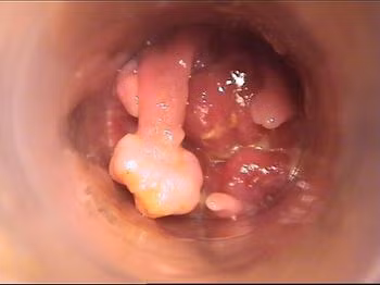  3. U cục: Ở phần viền hậu môn xuất hiện cục u nhỏ, phát triển chậm. Lúc này, tốt nhất nên đến bệnh viện để chụp CT, đồng thời có thể xác định được tính chất khối u.