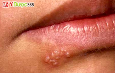 6. Cảm giác không bình thường hoặc liên tục bị tê, ngứa ran, đau hoặc dị cảm trong môi không rõ lý do có thể là một trong những triệu chứng.