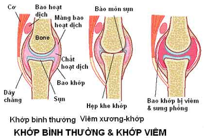 Viêm xương khớp là hình thức phổ biến nhất của viêm khớp. Bệnh làm ảnh hưởng đến sự tăng trưởng chung của sụn và xương xung quanh các cạnh của khớp, gây ra các cơn đau và cho phép các khớp di chuyển mà không có ma sát.