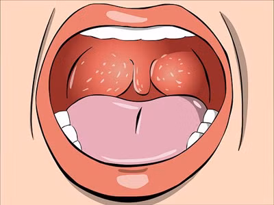 2. Ung thư vòm họng. Ung thư phát sinh trong khu vực vòm họng, trong đó lỗ mũi và các ống eustachian kết nối với phần trên của cổ họng.