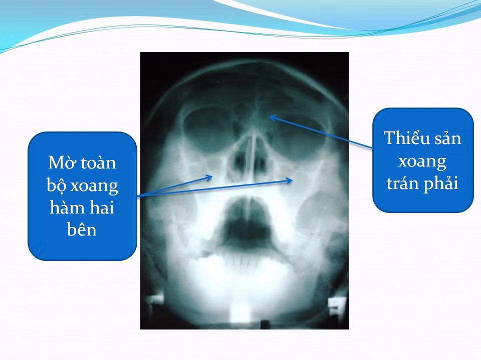 Kiểm tra X-quang là phương pháp phổ biến nhất, có thể bao quát toàn bộ phạm vi của ung thư và sự hủy diệt của nền sọ. Nó rất hữu ích trong việc xác định các giai đoạn và kế hoạch điều trị ung thư mũi họng.