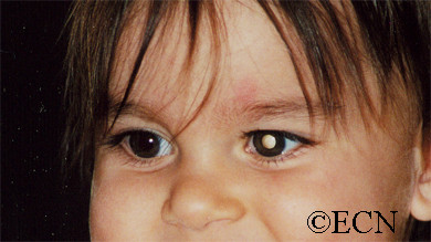 Các triệu chứng bao gồm màu trắng ở trung tâm mắt. Mắt nhìn theo những hướng khác nhau, trở thành màu đỏ và sưng lên do ung thư.