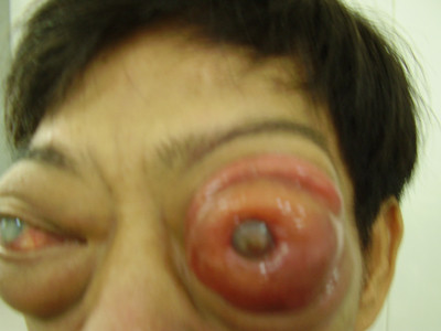 7. Ung thư mắt: Ung thư có thể phát triển trong da của mí mắt. Khi xảy ra, chúng thường có một loại gọi là khối u ác tính ở mắt . Đôi khi bệnh ung thư của các tế bào máu trắng, được gọi là ung thư hạch, có thể phát triển đằng sau mắt.