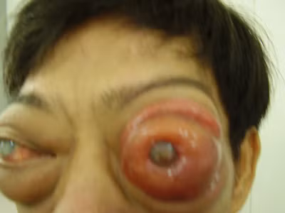 7. Ung thư mắt: Ung thư có thể phát triển trong da của mí mắt. Khi xảy ra, chúng thường có một loại gọi là khối u ác tính ở mắt . Đôi khi bệnh ung thư của các tế bào máu trắng, được gọi là ung thư hạch, có thể phát triển đằng sau mắt.