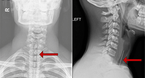 3. X-quang có thể tiết lộ rõ ​​vị trí, kích thước và hình dạng của các tổn thương ung thư thanh quản cũng như sự thay đổi của các mô đốt sống cổ. Khi cần thiết, chụp X quang thanh quản có thể được thực hiện.