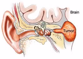 Schwannoma tiền đình (u thần kinh âm thanh) là một khối u lành tính của các dây thần kinh cân bằng trong ống xương giữa tai và não, và đôi khi phát triển khá lớn đối với não.