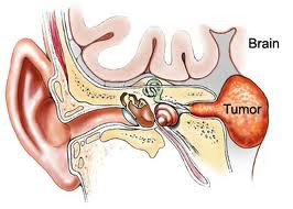 Schwannoma tiền đình (u thần kinh âm thanh) là một khối u lành tính của các dây thần kinh cân bằng trong ống xương giữa tai và não, và đôi khi phát triển khá lớn đối với não.