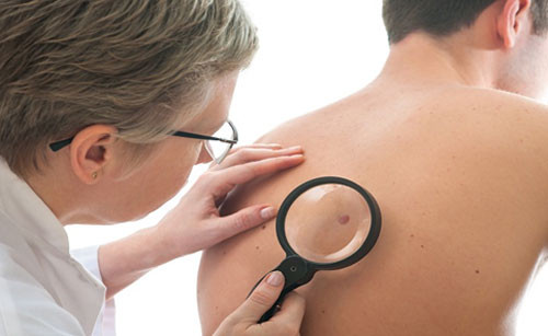 Phương pháp mới giúp phát hiện ung thư da ác tính. (Ảnh minh họa)