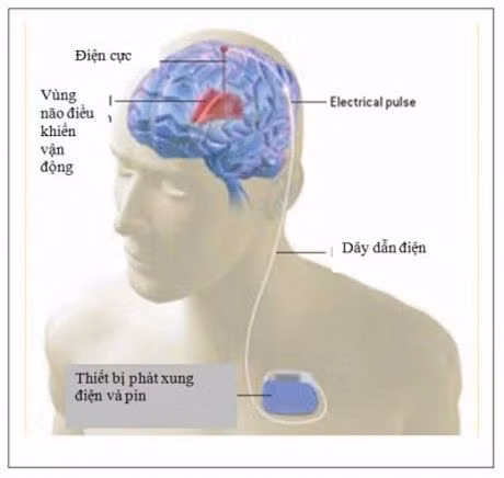 Phương pháp điều trị kích thích não sâu, gần đây đã được FDA chấp thuận, đang trở thành nguồn hi vọng mới cho mọi người. Nó bao gồm việc cấy một thiết bị điện nhỏ trong não để giảm các triệu chứng Parkinson.