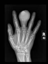 5. U xương: khối u tế bào nhỏ, tròn phát sinh trong xương hoặc các mô mềm. Thường được tìm thấy trong cánh tay, chân, xương chậu (xương hông) hoặc ngực.