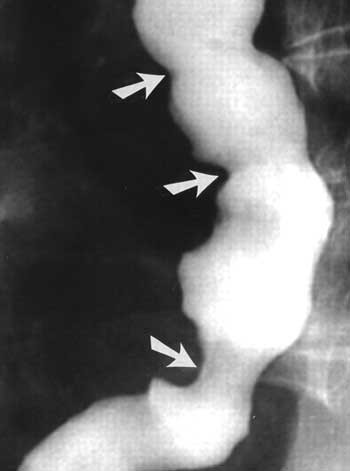 7. Tia phóng xạ: sử dụng tia phóng xạ để điều trị các khối u ở cổ có thể gây ra bệnh ung thư thanh quản.