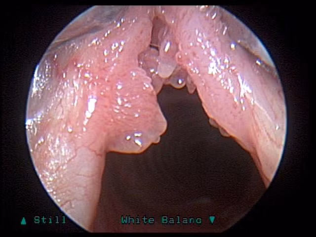 6. Tổn thương tiền ung thư: bất kỳ sự tái phát của chứng dày sừng thanh quản và ung thư thanh quản lành tính, như u nhú ở thanh quản, có thể chuyển đổi đến ung thư.