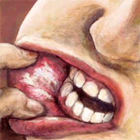 Vết loét màu trắng hoặc xám trong miệng hoặc môi gọi là bạch sản (chứng dày sừng), được gây ra bởi răng thô, hàm răng giả bị hỏng, hoặc thuốc lá. Thói quen nhai bên trong của má hoặc môi cũng có thể làm phát triển quá mức tế bào dẫn đến bạch sản. Mô này là bất thường và có thể trở thành ác tính, nhưng chủ yếu là lành tính.