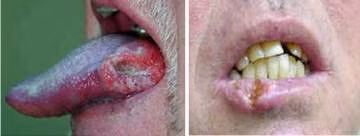 Ung thư tế bào vảy là phổ biến nhất, bao gồm cả bên trong môi, lưỡi, sàn miệng, và vòm miệng cứng. Ung thư khoang miệng gây ra do sử dụng thuốc lá cũng như rượu nặng. Ung thư khu vực này, đặc biệt là lưỡi, thường được điều trị bằng phẫu thuật.