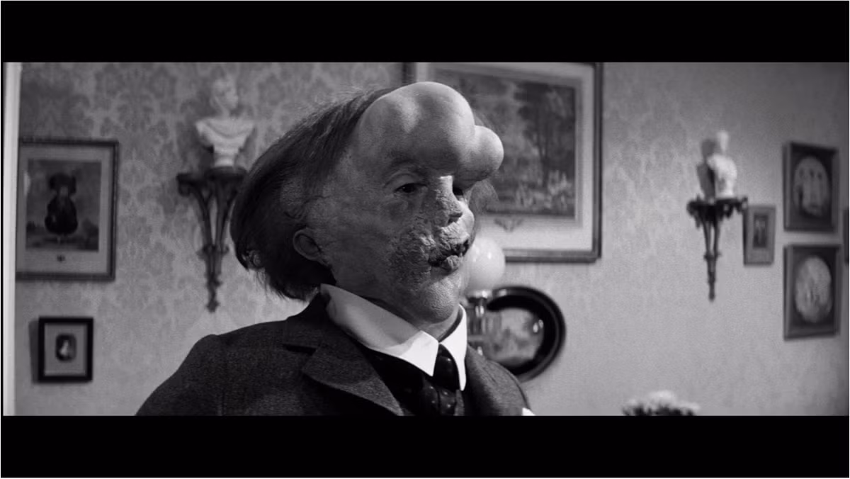 Joseph Merrick Carey - biệt danh "Người Voi" - sinh năm 1862 ở Leicester. Các khối u trên cơ thể bắt đầu phát triển, biến dạng khi lên 2 và tình trạng của ông xấu đi nhanh chóng.