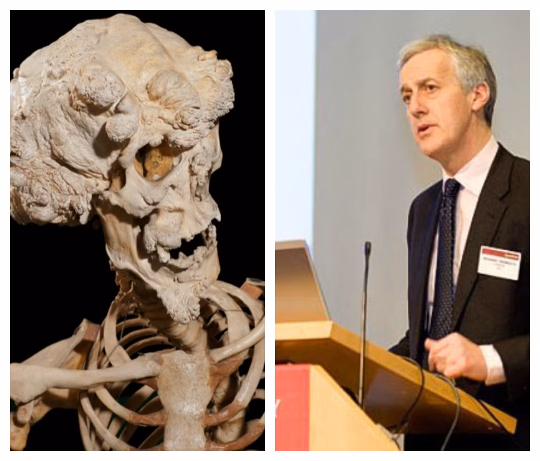 Giáo sư Richard Trembath của Đại học Queen Mary (ảnh phải), nơi xương được lưu trữ, nói với BBC rằng vấn đề di truyền cơ bản liên quan tới sự phát triển quá mức các mô trong "Người Voi" cũng có thể tiết lộ những manh mối cách một tế bào phát triển, và làm thế nào để ngăn chặn nó.