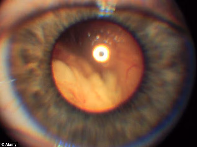 Cậu bé bị ảnh hưởng bởi triệu chứng nguyên bào võng mạc. Dấu hiệu phổ biến nhất bao gồm một sự phản ánh trắng trong con ngươi thường cho ra ảo ảnh hoặc ánh sáng mờ. (Ảnh: mắt trái bị ảnh hưởng)