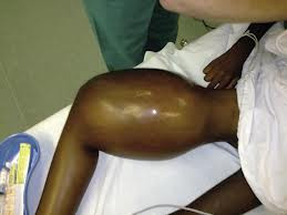 6. U xương ác tính: hình thức phổ biến nhất của ung thư xương ở trẻ em. Nó xảy ra thường xuyên nhất trong xương ở chân hoặc ở cánh tay .