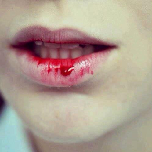 4. Chảy máu từ vết loét hoặc lở loét không lành trên môi.